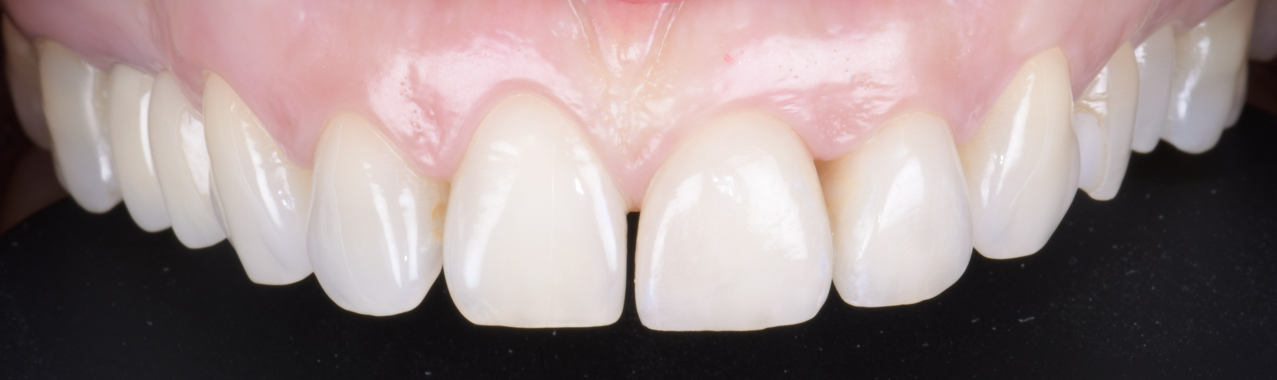 Sourire après la pose de facettes céramiques, rendu naturel