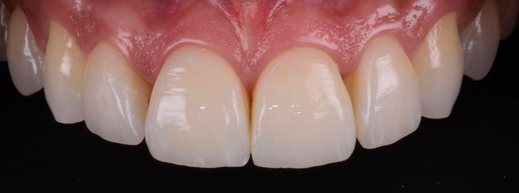 Sourire après la pose de facettes céramiques, rendu naturel
